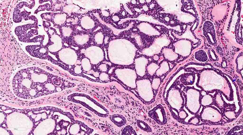 Adenoid cystic carcinoma - carcinoma
