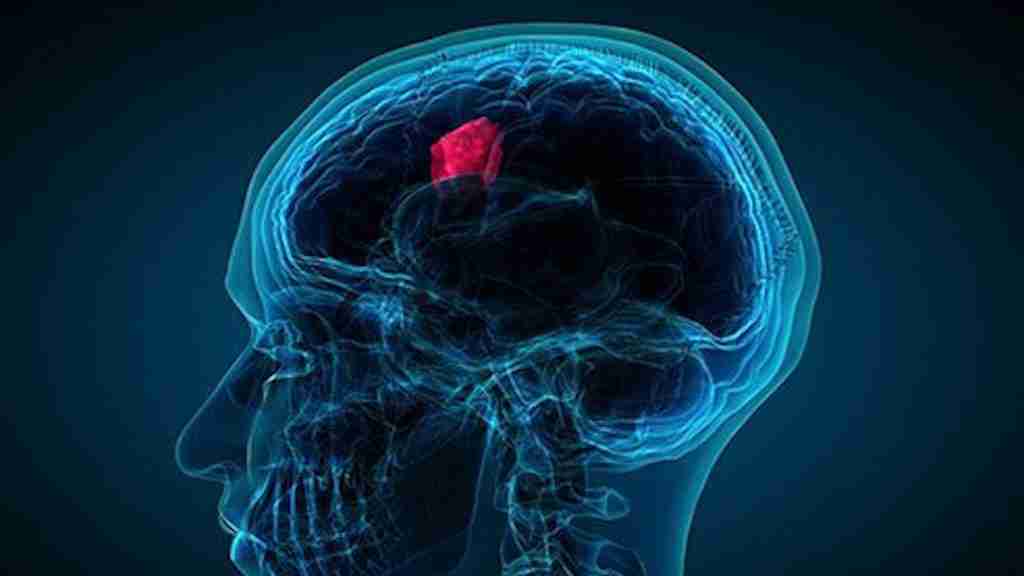 Brain tumor - neoplasm