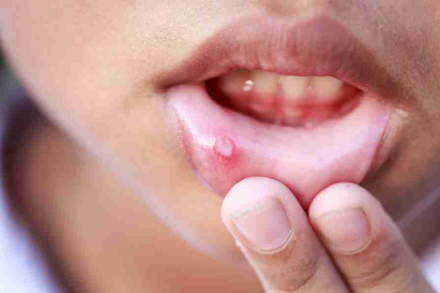 Mouth ulcer - Aphthous ulcer