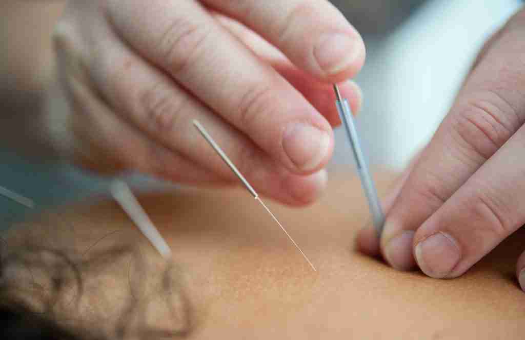 Acupuncture - Therapy