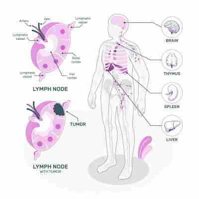 Non-hodgkin’s lymphoma symptoms and holistic treatments