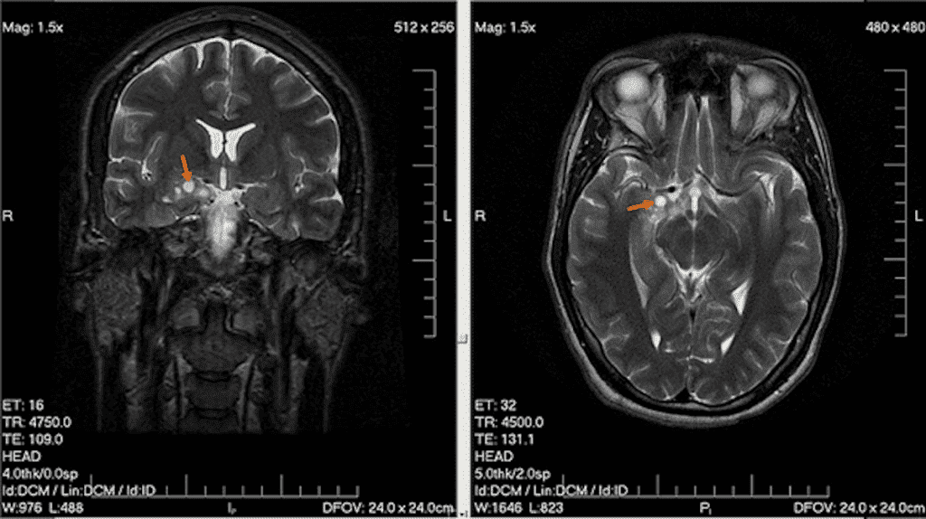 Brain tumor - Glioma