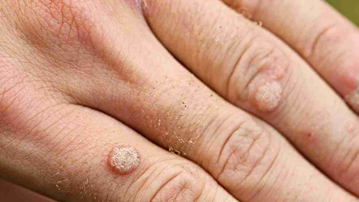 What types of skin cancer look like warts?